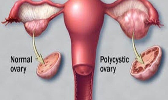 Gynecologist in Bellandur and Sarjapur Road - PCOD/PCOS
